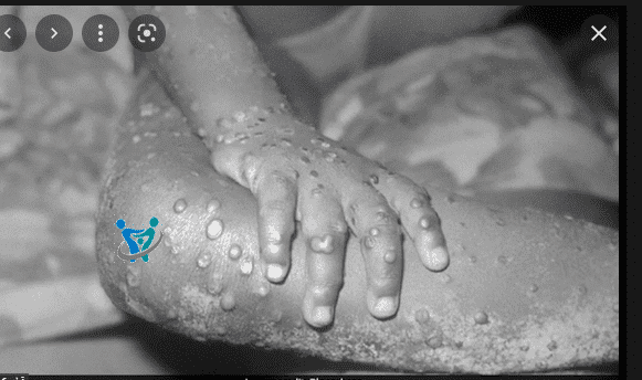 ماهو جدري القرود أسبابه وعلاجه 1 ماهو جدري القرود أسبابه وعلاجه